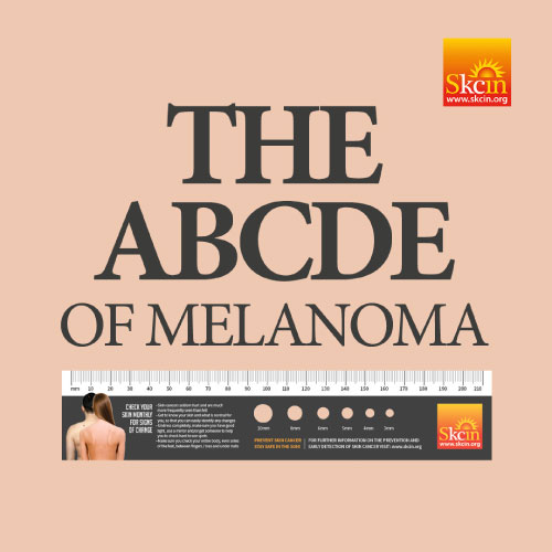 The ABCDE of Melanoma